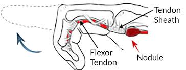 دکتر حسین ارجمند, متخصص طب فیزیکی و توانبخشی, شیراز, انگشت ماشه ای,trigger finger